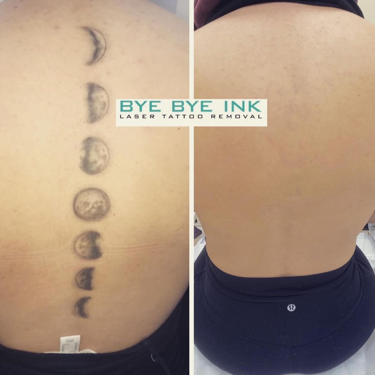 Let's Talk Laser Tattoo Removal: Part 1
