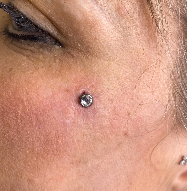 Facial Dermal