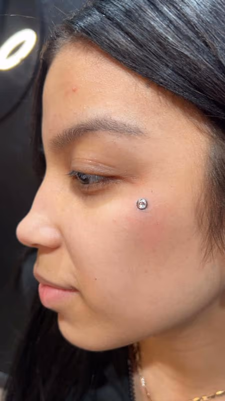 Facial dermal implant by Kimer