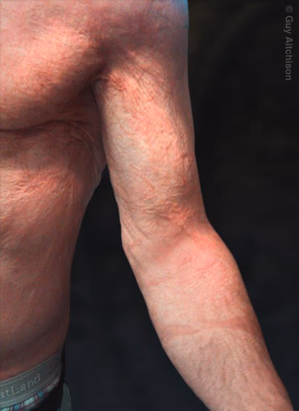 Kevin, massive electrical burn scar, before