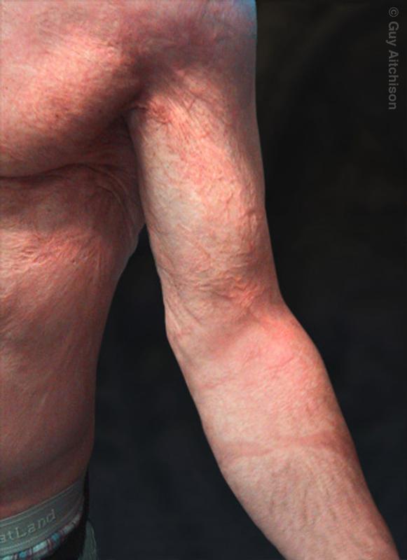 Kevin, massive electrical burn scar, before