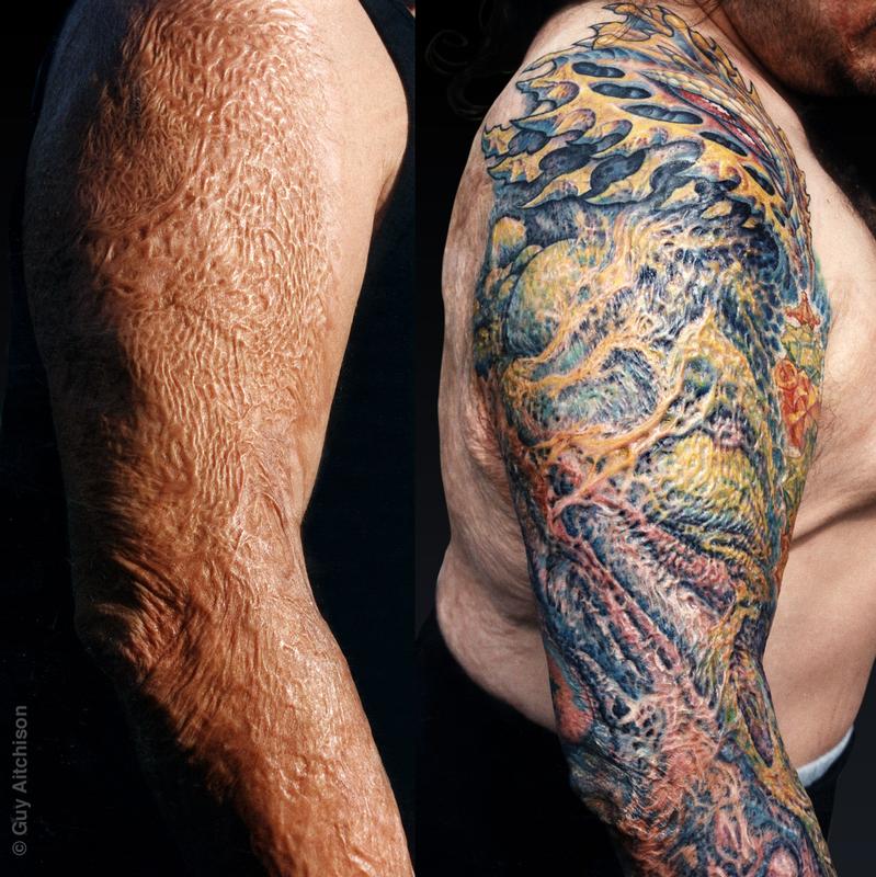 Anthony, third degree burn scar coverup