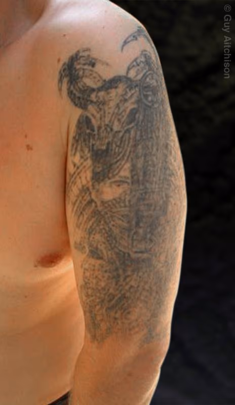 Uli, before (showing 4 laser sessions)