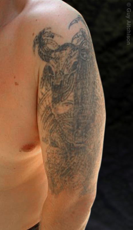 Uli, before (showing 4 laser sessions)
