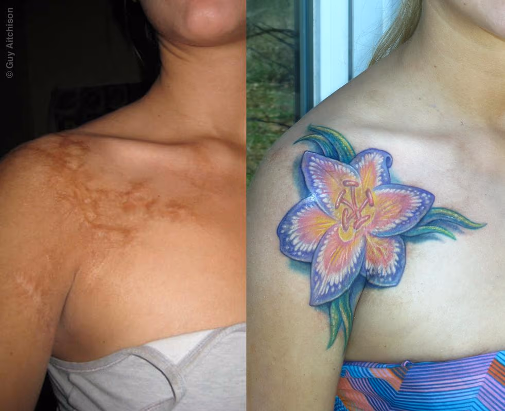 Nicole, childhood coffee burn scar, before and after