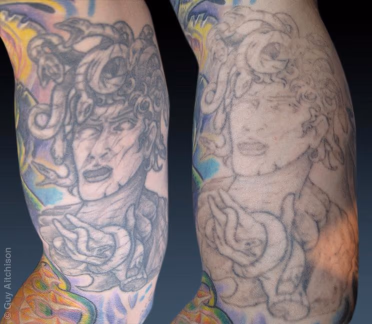 Don, before and after several laser sessions