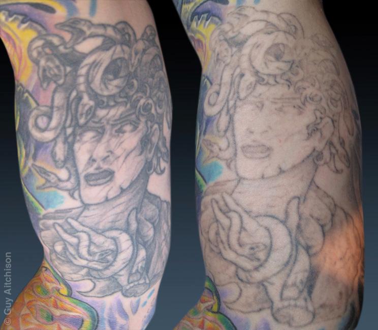 Don, before and after several laser sessions
