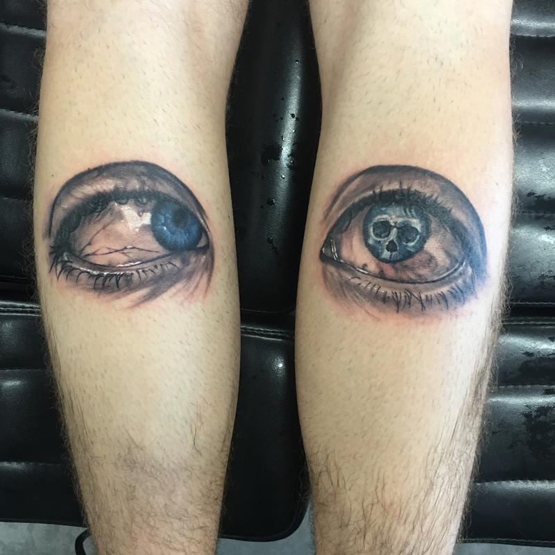 Duane syndrome eyes
