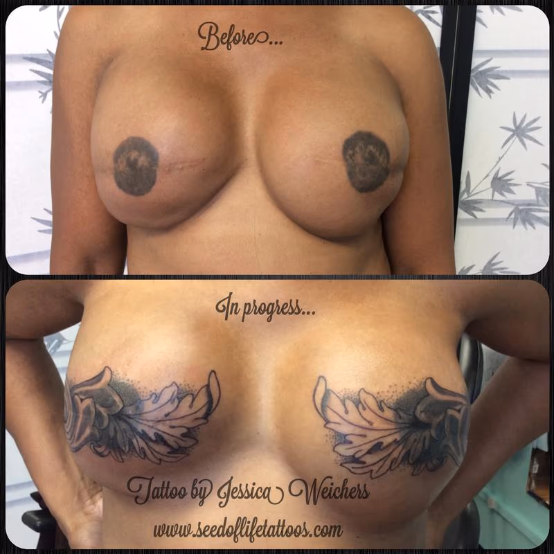 Mastectomy coverup