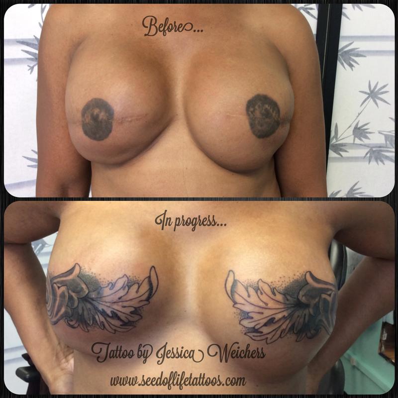 Mastectomy coverup