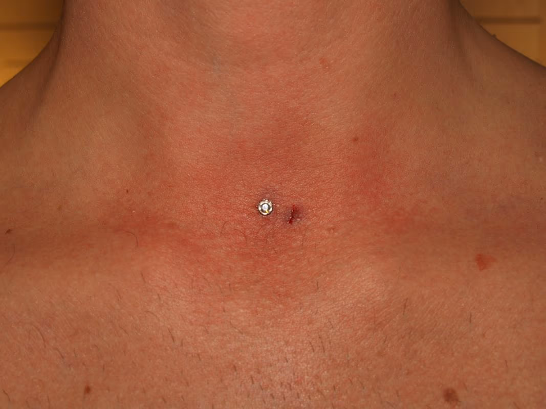 Dermal