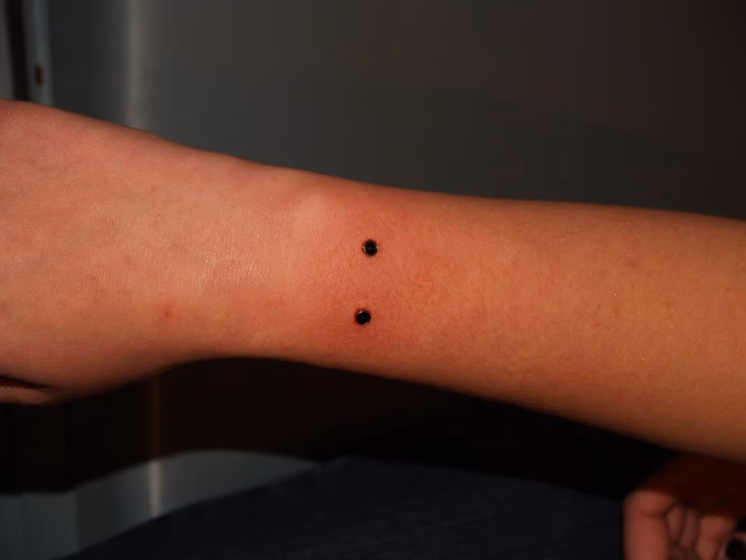 Wrist Dermals