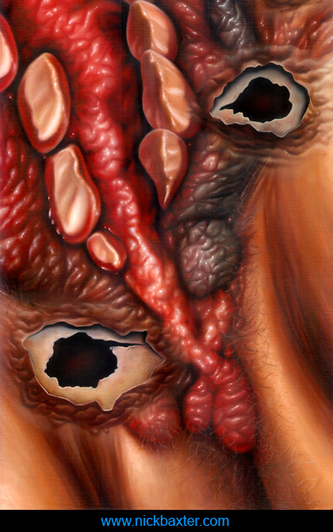 Malignant Transformation