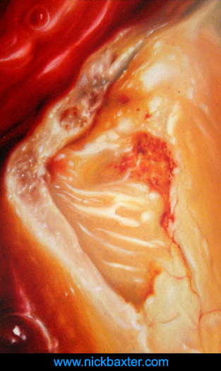 Abscess / Oil on Masonite / 2006 / 3.5" x 2" / Private Collection